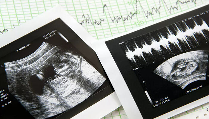 ABORTIONS SHOULD BE INCLUDED IN MORTALITY STATISTICS—RUSSIAN CHURCH REP