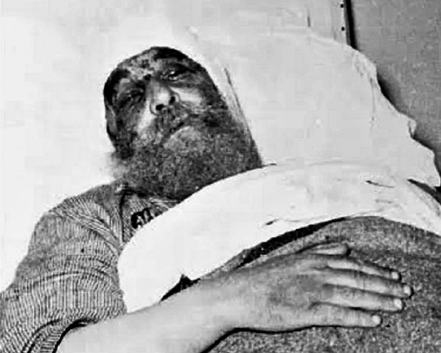 Εσκαψαν λάκκο οι Τούρκοι, άναψαν φωτιά και τον έκαιγαν ζωντανό